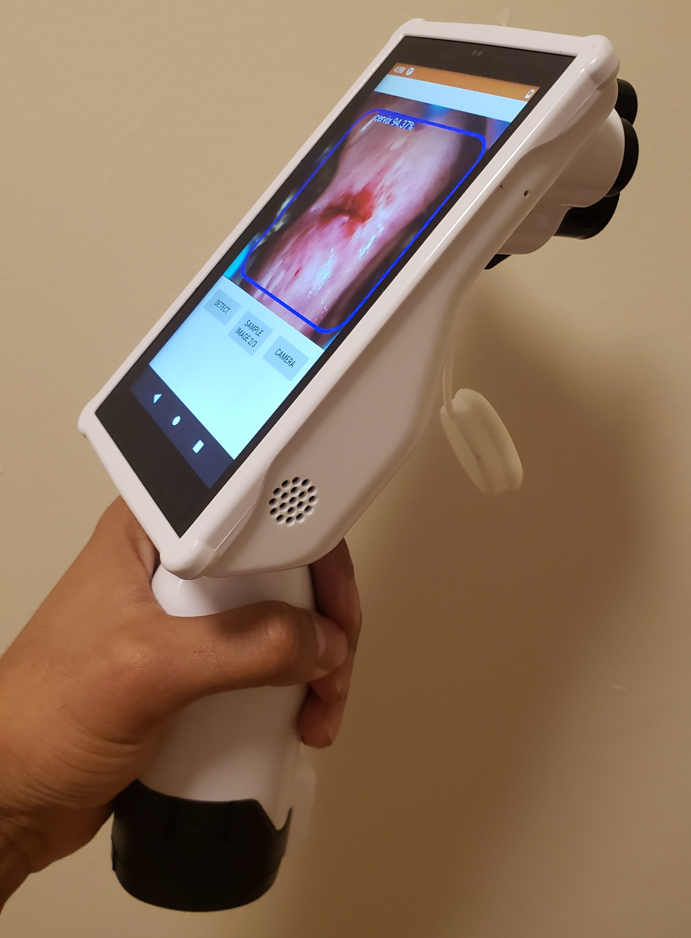 Globally Deployed Cervical Cancer AI